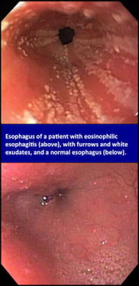 Eosinophilic esophagitis esophagus versus normal esophagus.